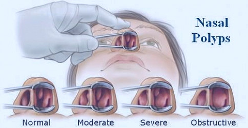 Nasal Polyps Surgery in NJ & NYC | Sinus Surgeon Dr. Tadros